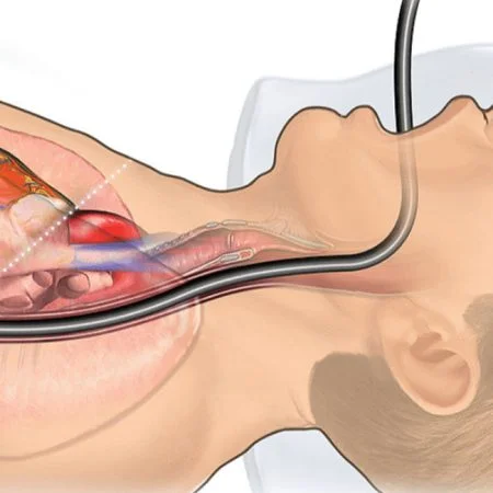 Gastroscopy